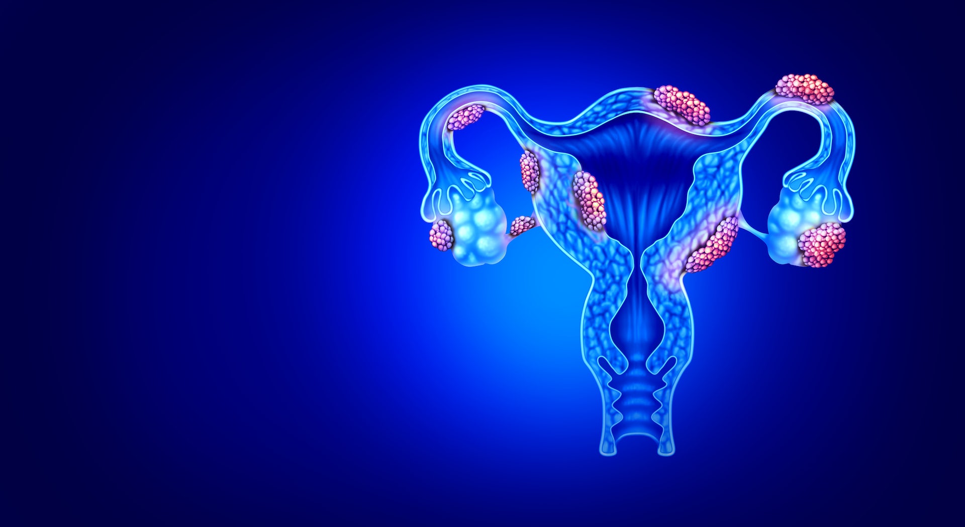 Endometriosis: how the condition may be linked to the immune system