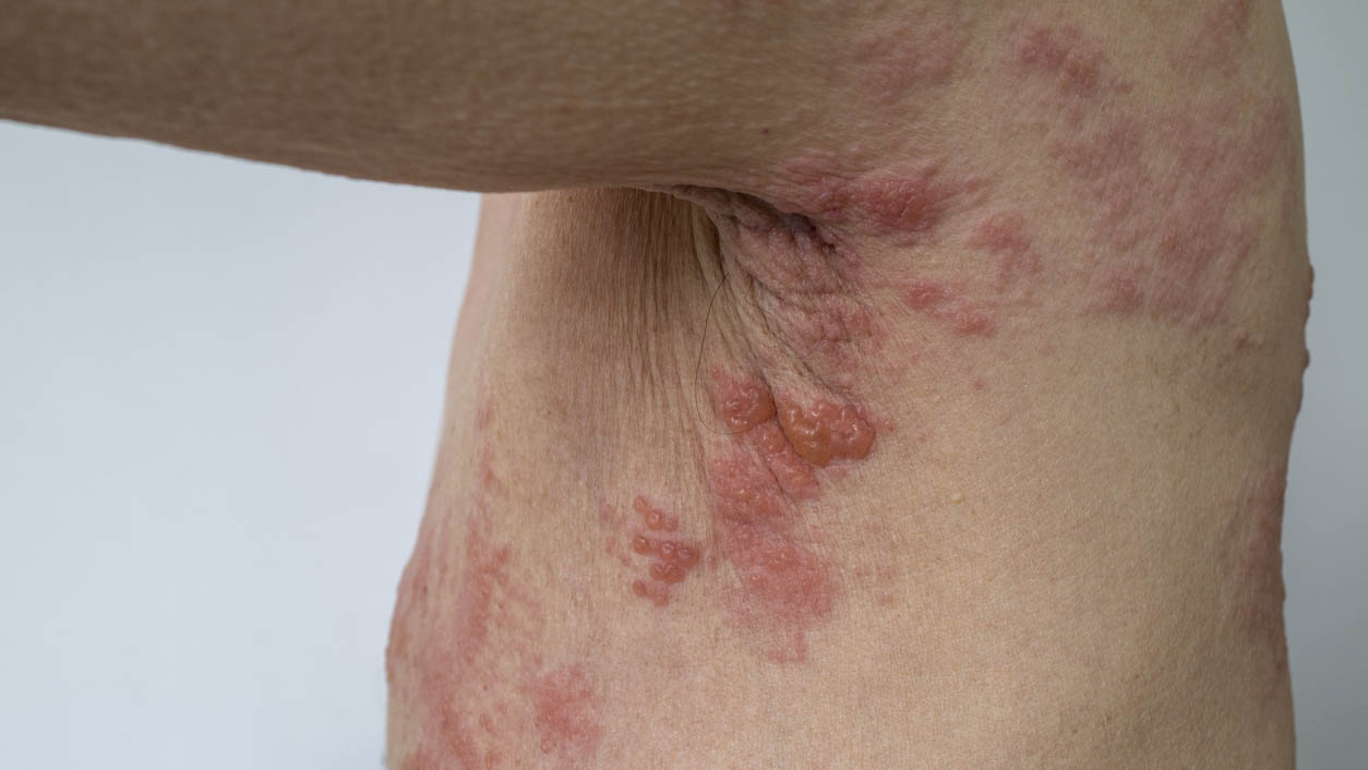 More Australians will be able to get a free vaccine for shingles
